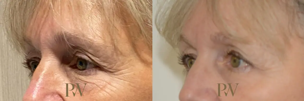 Paul Wilson - Eyelid Surgery Patient Image 2