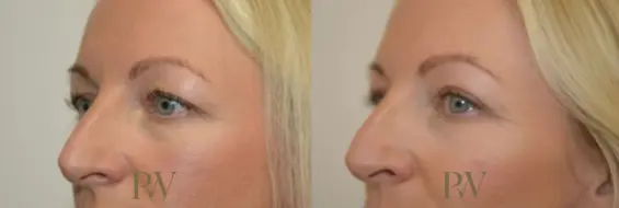 Paul Wilson - Eyelid Surgery Patient Image 20