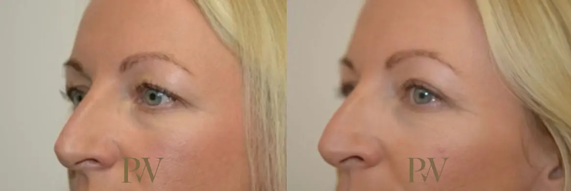 Paul Wilson - Eyelid Surgery Patient Image 20