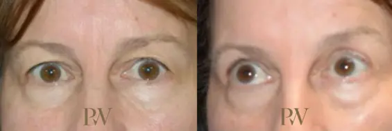 Paul Wilson - Eyelid Surgery Patient Image 21