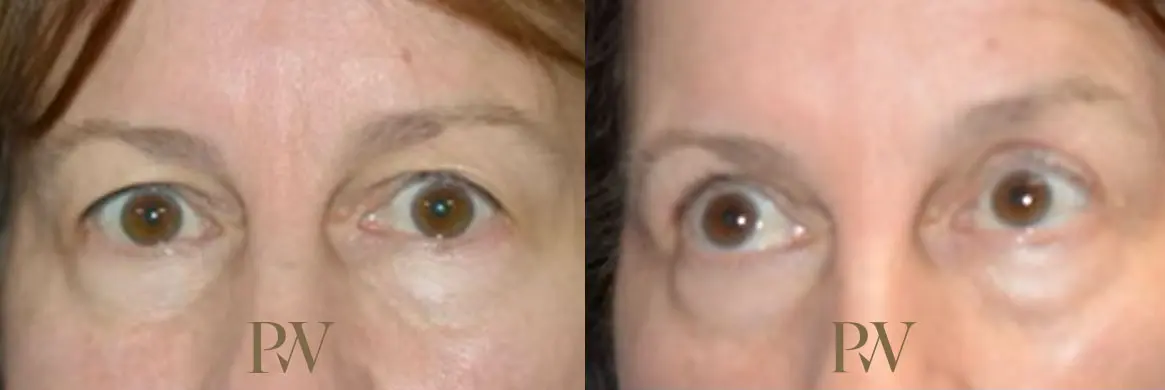 Paul Wilson - Eyelid Surgery Patient Image 21