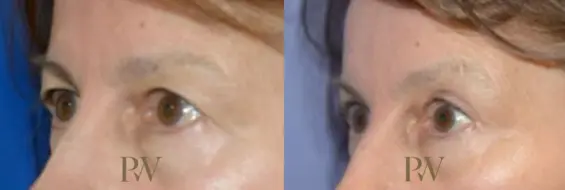 Paul Wilson - Eyelid Surgery Patient Image 22