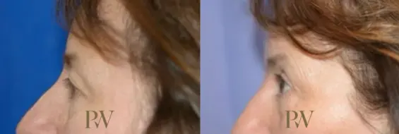 Paul Wilson - Eyelid Surgery Patient Image 23