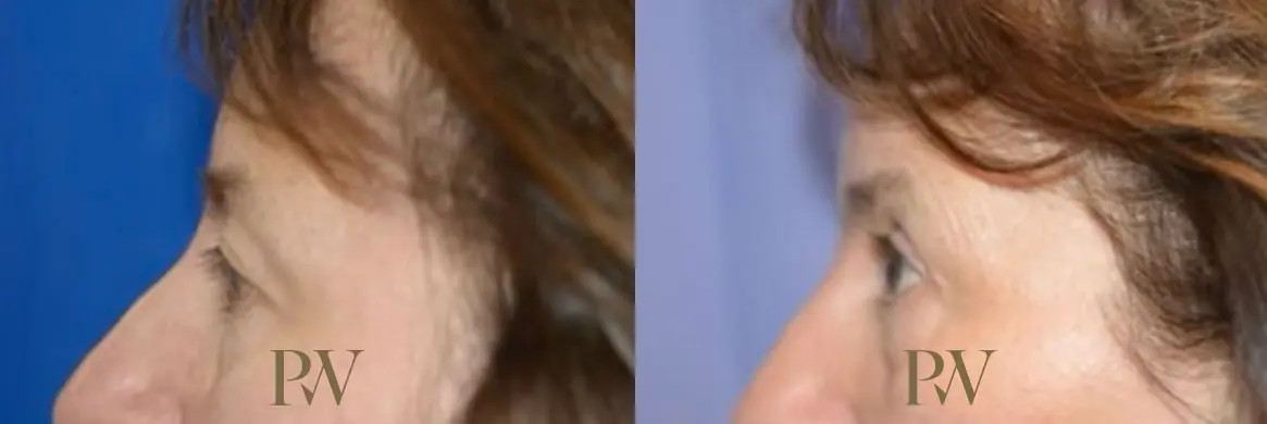 Paul Wilson - Eyelid Surgery Patient Image 23