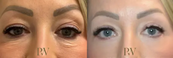 Paul Wilson - Eyelid Surgery Patient Image 24