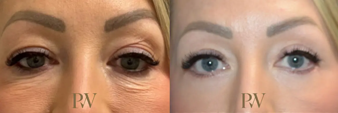 Paul Wilson - Eyelid Surgery Patient Image 24