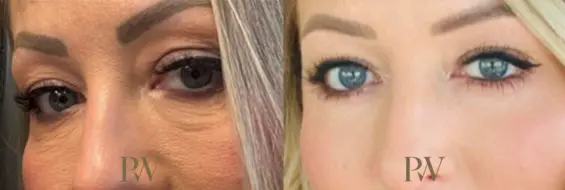 Paul Wilson - Eyelid Surgery Patient Image 25