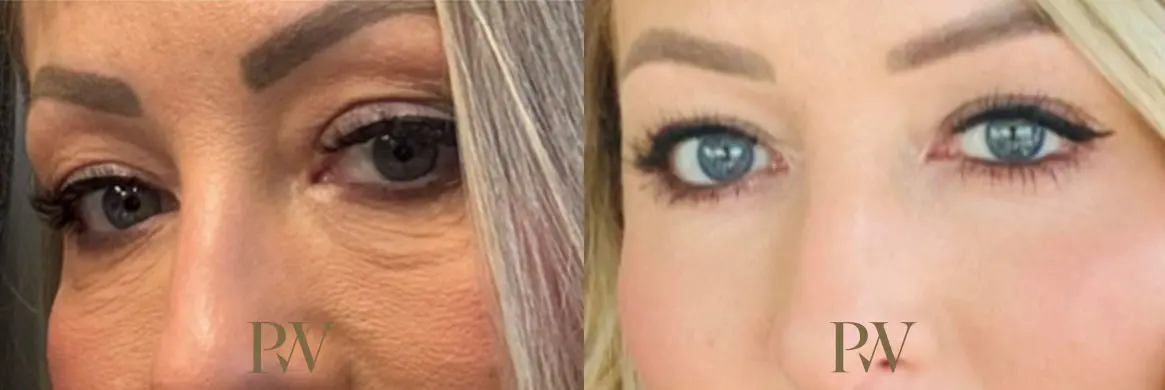 Paul Wilson - Eyelid Surgery Patient Image 25