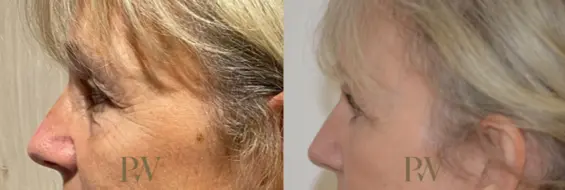 Paul Wilson - Eyelid Surgery Patient Image 3