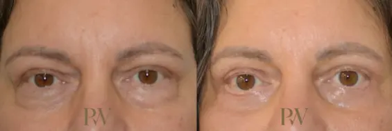 Paul Wilson - Eyelid Surgery Patient Image 4