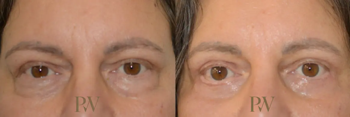 Paul Wilson - Eyelid Surgery Patient Image 4