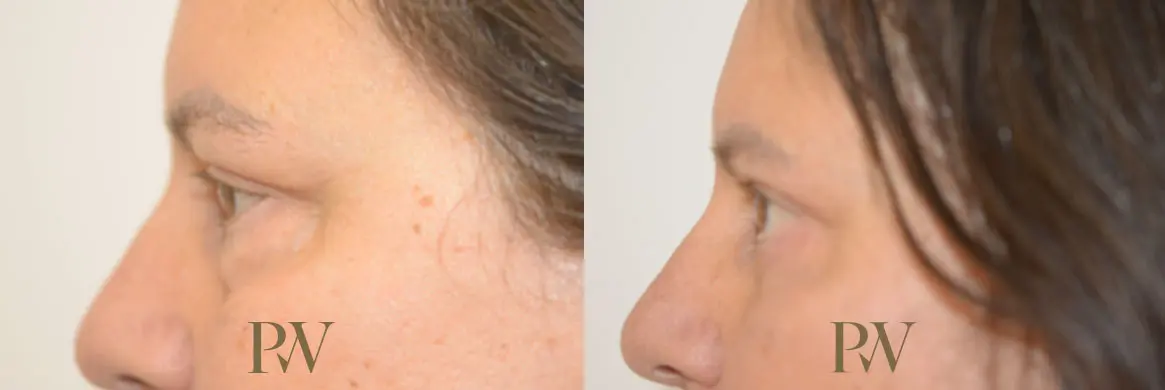 Paul Wilson - Eyelid Surgery Patient Image 5