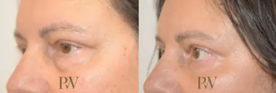 Paul Wilson - Eyelid Surgery Patient Image 6