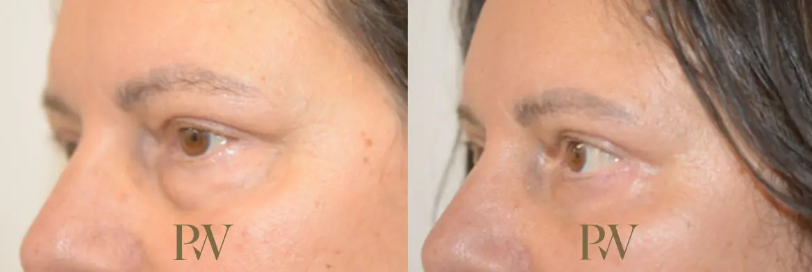 Paul Wilson - Eyelid Surgery Patient Image 6