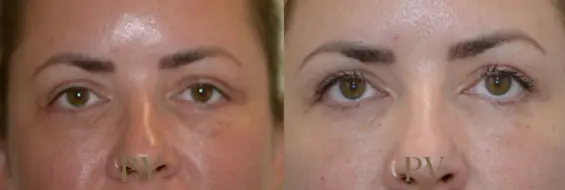 Paul Wilson - Eyelid Surgery Patient Image 7