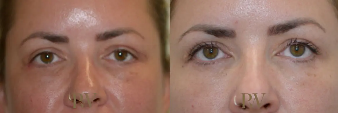 Paul Wilson - Eyelid Surgery Patient Image 7