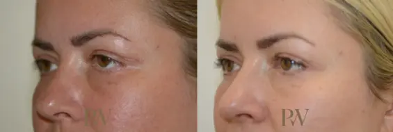 Paul Wilson - Eyelid Surgery Patient Image 8