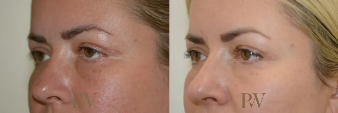 Paul Wilson - Eyelid Surgery Patient Image 8