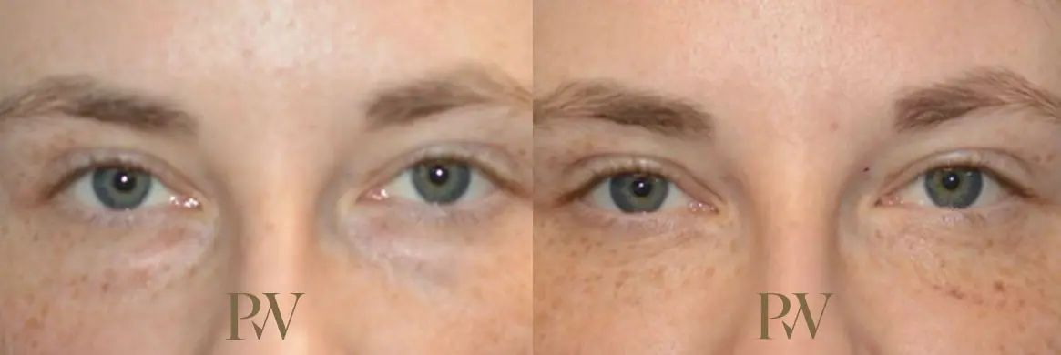 Paul Wilson - Eyelid Surgery Patient Image 9