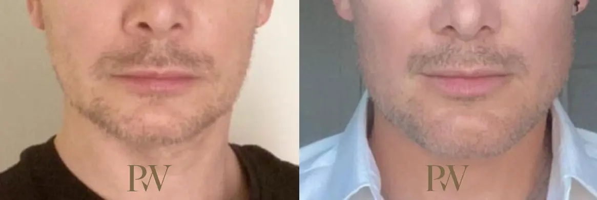 Paul Wilson - Facial Implants Patient Image 1