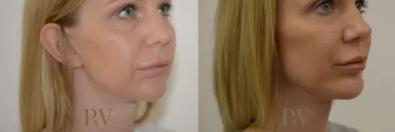 Paul Wilson - Facial Implants Patient Image 11