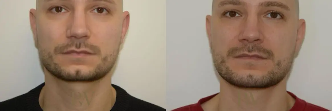 Paul Wilson - Facial Implants Patient Image 12