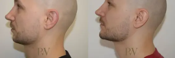 Paul Wilson - Facial Implants Patient Image 13