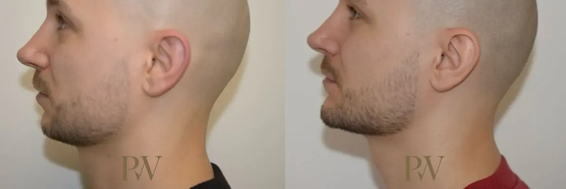 Paul Wilson - Facial Implants Patient Image 13