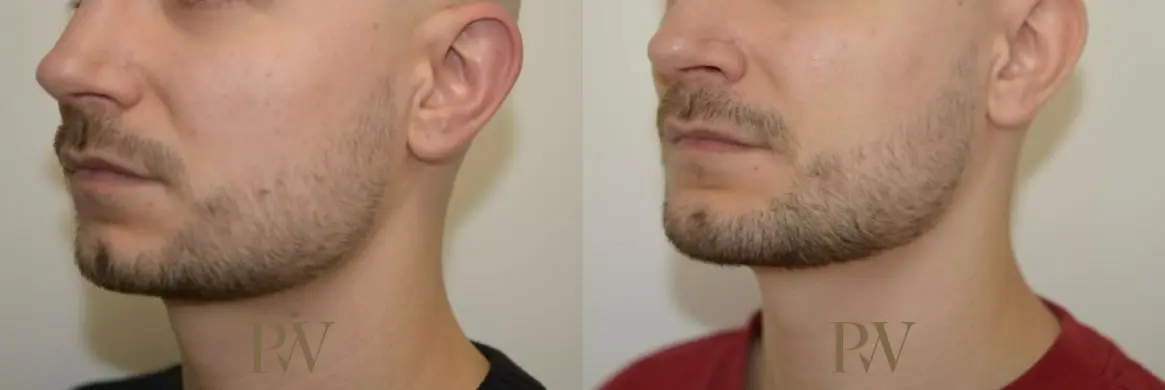 Paul Wilson - Facial Implants Patient Image 14