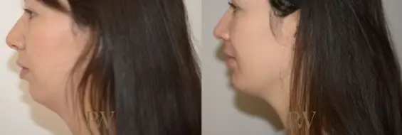 Paul Wilson - Facial Implants Patient Image 15