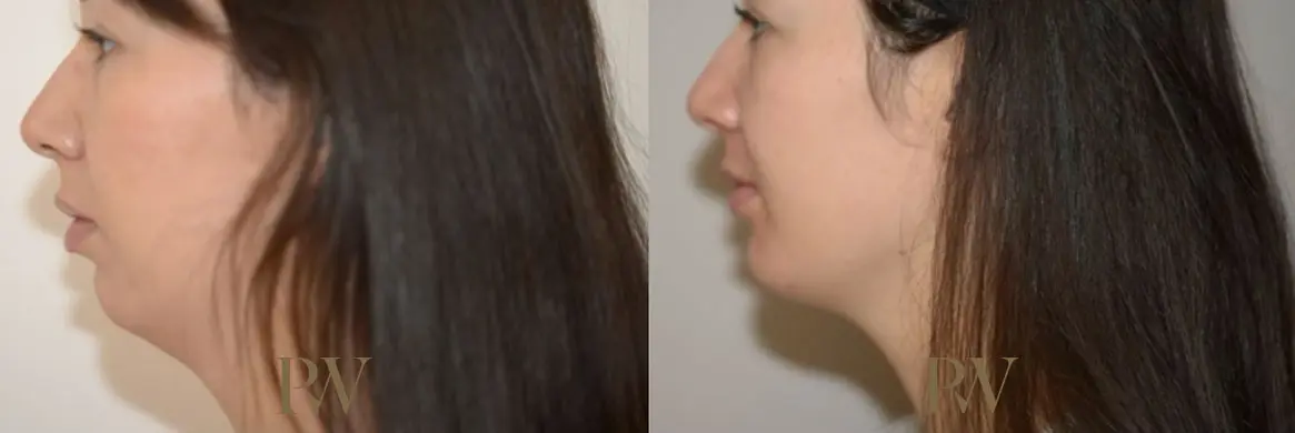 Paul Wilson - Facial Implants Patient Image 15