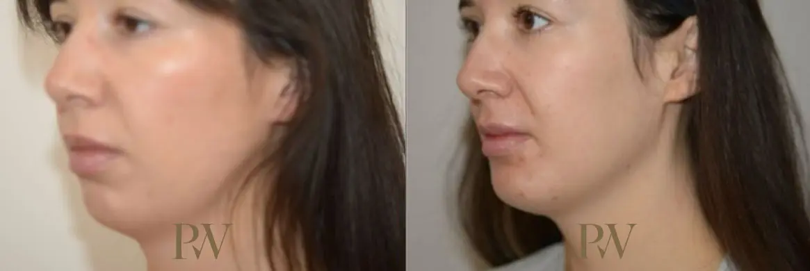 Paul Wilson - Facial Implants Patient Image 16