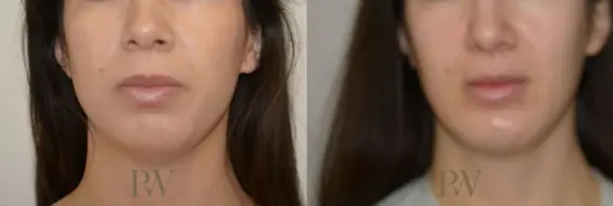 Paul Wilson - Facial Implants Patient Image 17