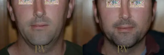 Paul Wilson - Facial Implants Patient Image 18