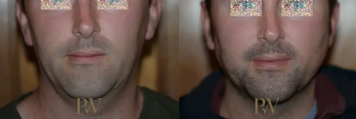 Paul Wilson - Facial Implants Patient Image 18