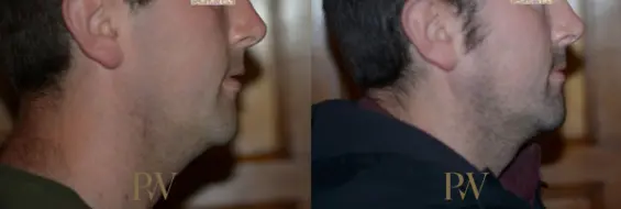 Paul Wilson - Facial Implants Patient Image 19