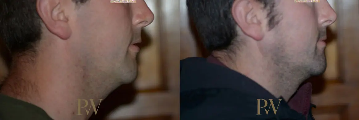 Paul Wilson - Facial Implants Patient Image 19