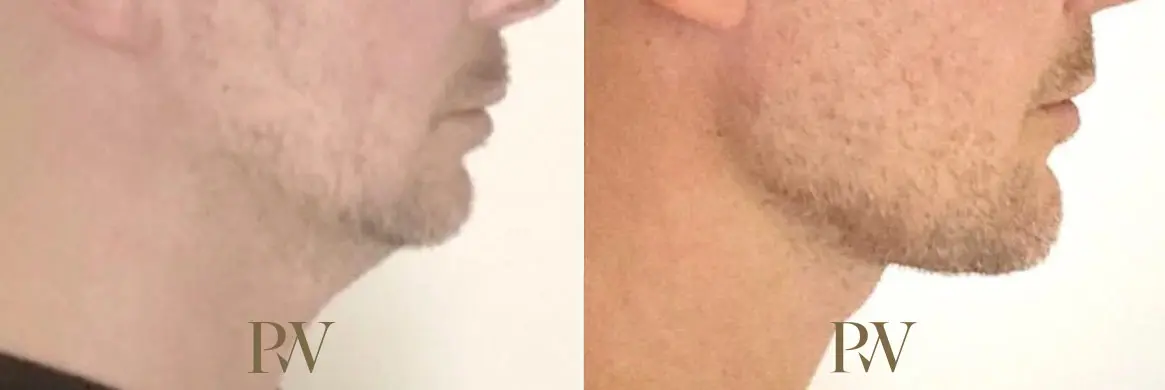 Paul Wilson - Facial Implants Patient Image 2