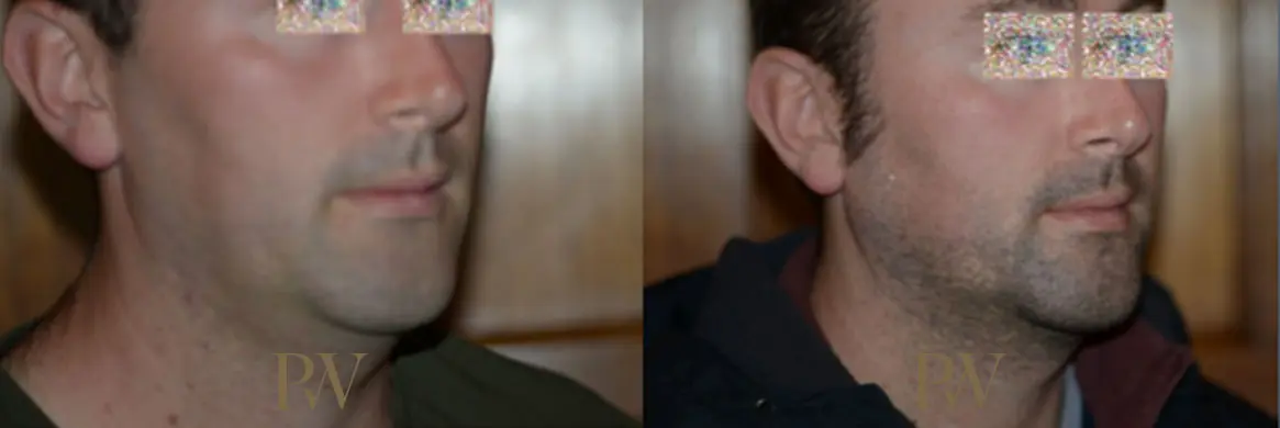 Paul Wilson - Facial Implants Patient Image 20