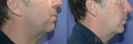 Paul Wilson - Facial Implants Patient Image 3