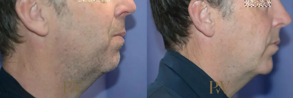 Paul Wilson - Facial Implants Patient Image 3