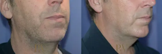 Paul Wilson - Facial Implants Patient Image 4