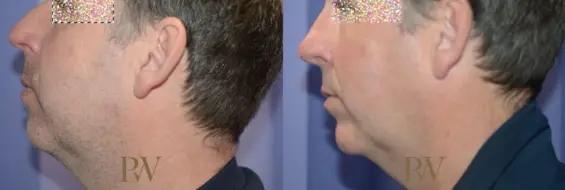 Paul Wilson - Facial Implants Patient Image 5