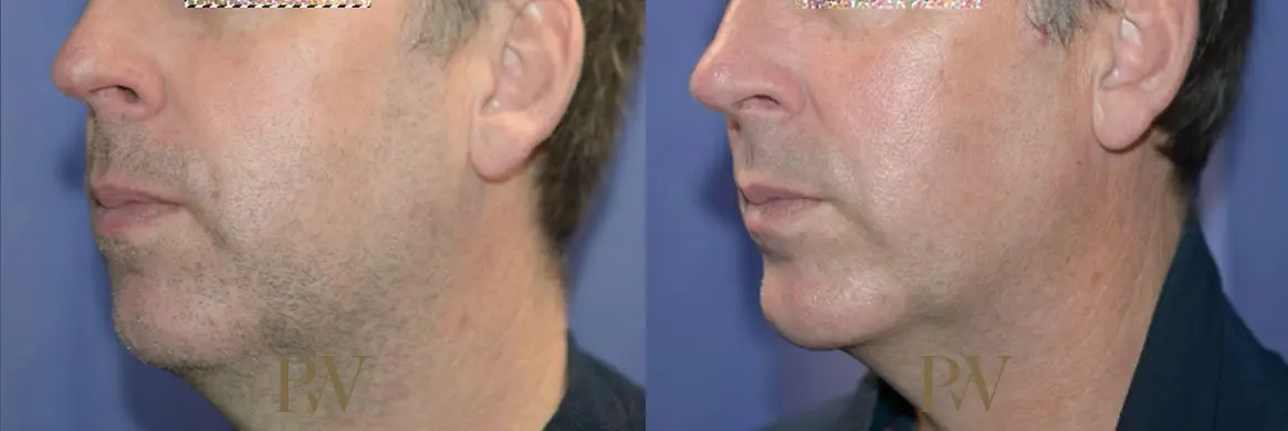 Paul Wilson - Facial Implants Patient Image 6