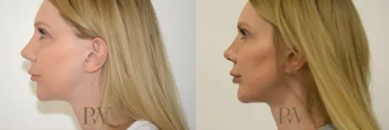 Paul Wilson - Facial Implants Patient Image 7