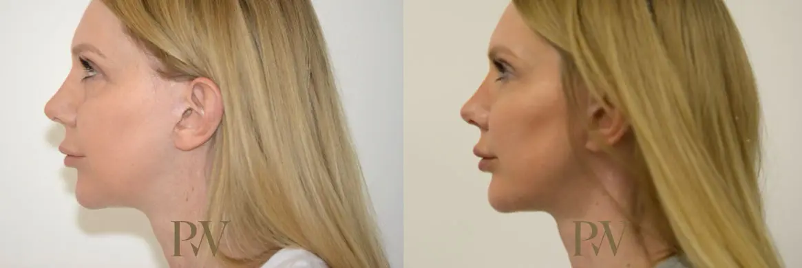 Paul Wilson - Facial Implants Patient Image 7