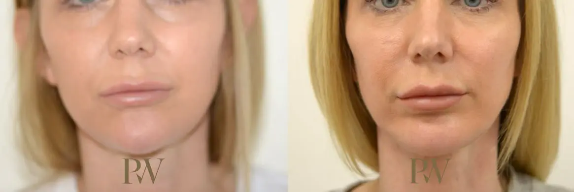 Paul Wilson - Facial Implants Patient Image 8