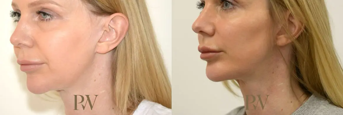 Paul Wilson - Facial Implants Patient Image 10