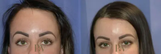 Paul Wilson - Hairline Lowering (Foreheadplasty) Patient Image 10