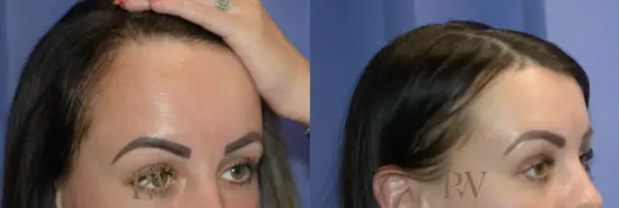 Paul Wilson - Hairline Lowering (Foreheadplasty) Patient Image 12